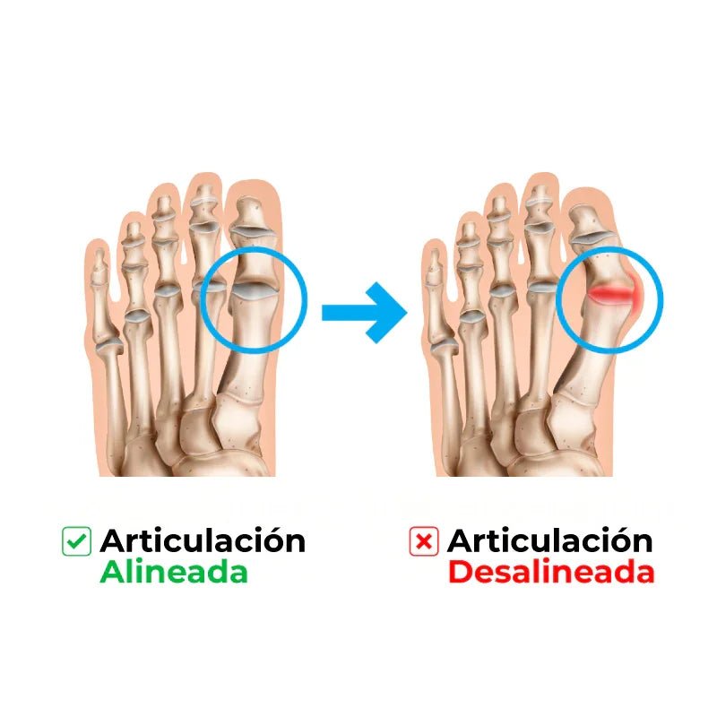 AliviFlex™️ – Acelera la alineación de tus juanetes mientras duermes - SereniVida Mexico